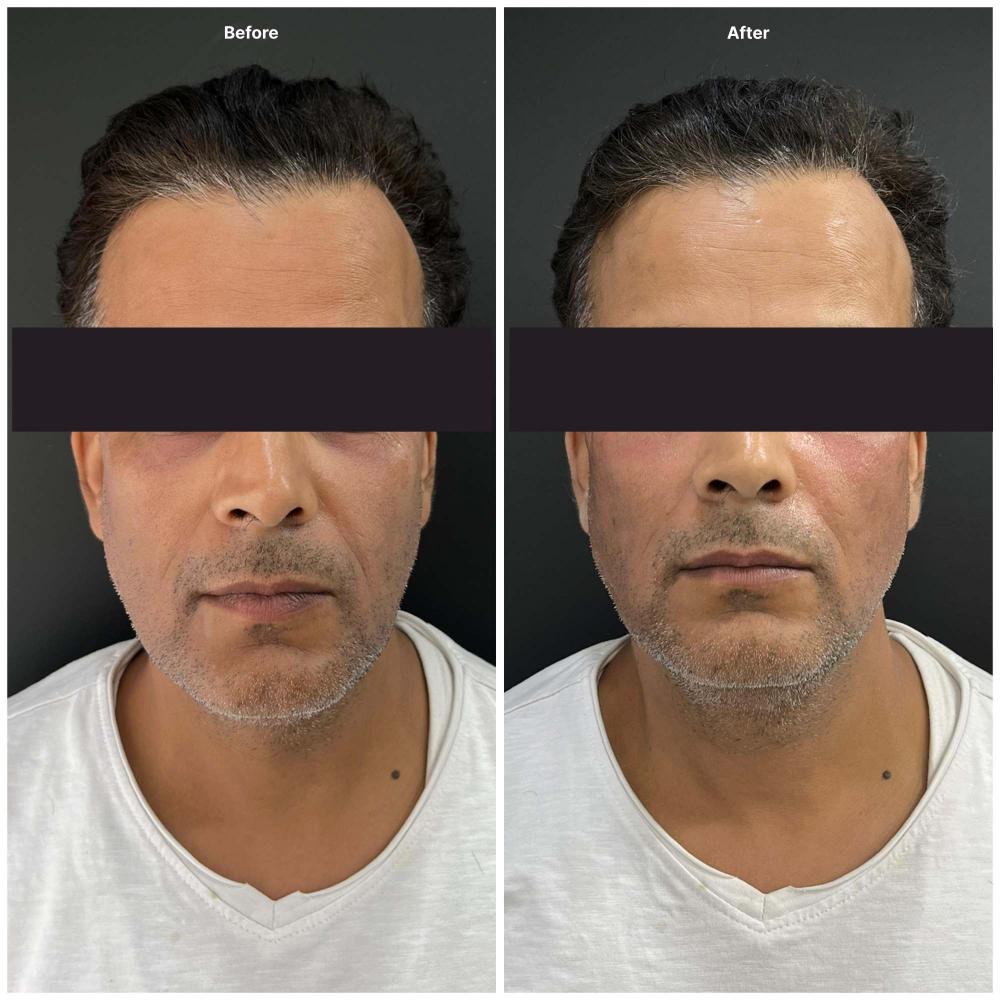 Botox result KOQ10